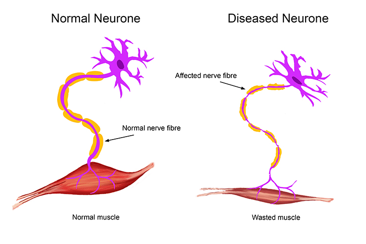 How Does Motor Neurone Disease Work